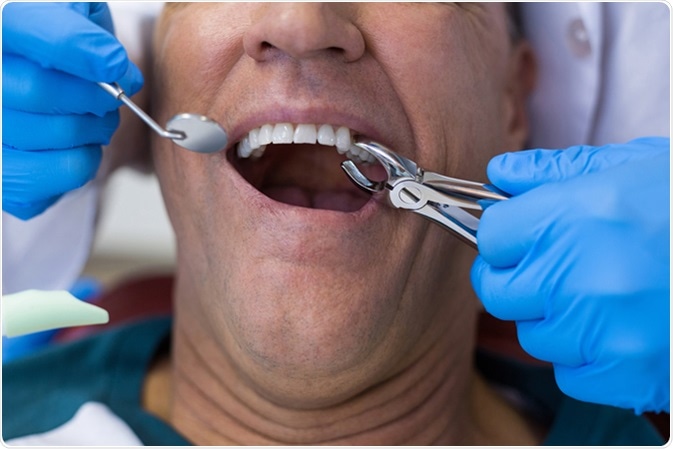 Dentist using surgical pliers to remove a decaying tooth in clinic. Image Credit: Wavebreakmedia / Shutterstock